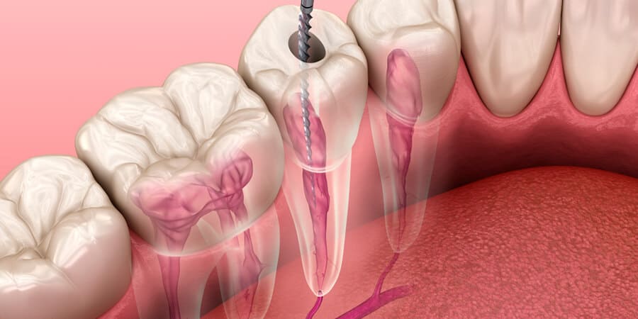 endodoncia-conductos-dientes