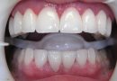 The Smile Makeover: How Porcelain Veneers in Rochdale Transform Lives